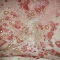 Bullous pemphigoid (copied with kind permission - Dermatoweb)