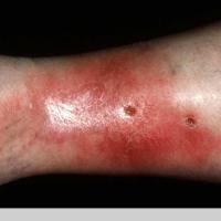 Cellulitis