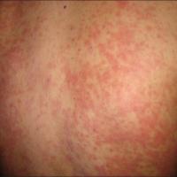 Drug Hypersensitivity syndrome