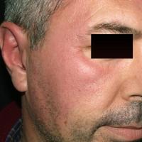 Erysipelas (copied with permission - Dermatoweb)