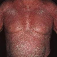 Erythroderma