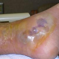 Necrotising fasciitis