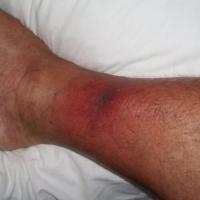 Necrotising fasciitis early - moderate/severe pain out of context to clinical findings