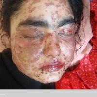 Stevens Johnson syndrome