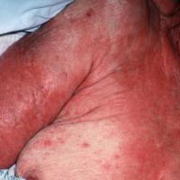 Toxic epidermal necrolysis