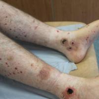 Vasculitis