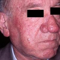 Rosacea - rhinophyma