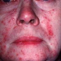 Rosacea - inflammatory with papules and pustules