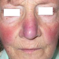 Rosacea - vascular