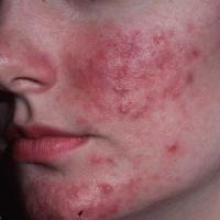 Rosacea 505
