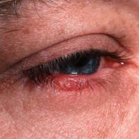 Rosacea - blepharitis