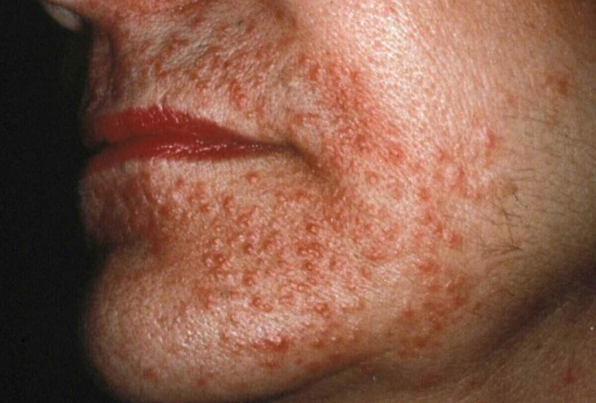 Photosensitive Rash Pcds Photosensitive Dermatitis: Causes, Symptoms, And Treatments – IAZDR