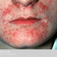 Perioral dermatitis - monomorphic papules