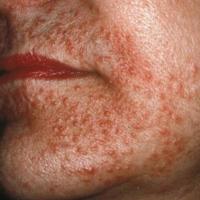 Perioral dermatitis