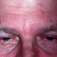 Seborrhoeic eczema - erythema, scale, and ocular involvement