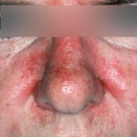 Seborrhoeic eczema