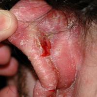 Seborrhoeic eczema (copied with kind permission - Dermatoweb)