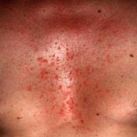 Seborrhoeic eczema