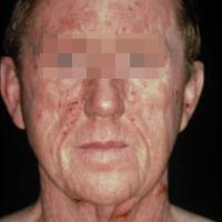 Airborne contact allergic dermatitis - not a photodermatosis and so no sparing of photo-protected areas