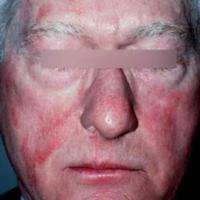 Drug-induced photosensitivity - sparing of photo-protected areas