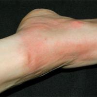 Solar urticaria