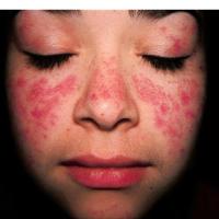 Systemic lupus erythematosus - malar rash, unwell, multisystem (copied with permission - Dermatoweb)
