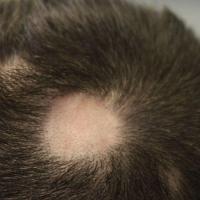 Alopecia arearta