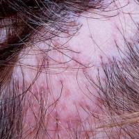 Scarring alopecia - lichen planopilaris. Erythematous patch that looks atrophic and shiny in areas. Scale centred on hair follicles (copied with permission - Dermatoweb)