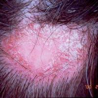 Scarring alopecia - lupus erythematosus. Erythematous patch, with hair loss. Shiny atrophic center, with scale around margin of the patch (copied with permission - Dermatoweb)