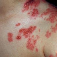 Herpes zoster
