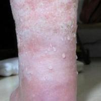 Leg oedema and blisters
