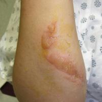 Phytophotodermatitis - caused by a reaction between contact with naturally occuring plant psoralens and UV exposure