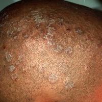 Tinea capitis: non-scarring