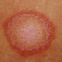 Tinea corporis (body) - itch, erythema and peripheral scale