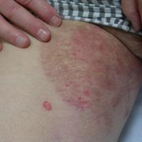 Tinea cruris (groin)