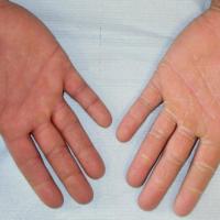 Tinea manuum (hands) - fine white scale, pronounced in the skin creases