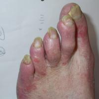 Tinea unguium - yellow