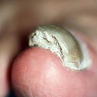 Tinea unguium - subungual debris
