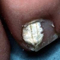 Tinea unguium (nail) - superficial. White surface change