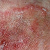 Tinea corporis - itch, erythema and scale