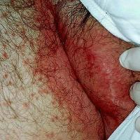 Candida with satellite lesions