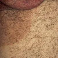 Erythrasma - older lesions are brown, sometimes with a wrinkled, scaly appearance (copied with permission - Dermatoweb)