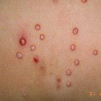Molluscum contagiosum (copied with kind permission - Dermatoweb)