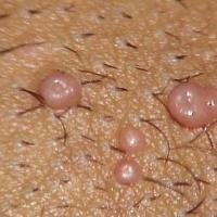 Molluscum contagiosum 501