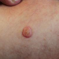 A large solitary lesion of molluscum contagiosum