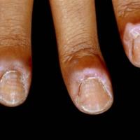Chronic paronychia