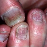 Lichen planus - longitudinal changes and thinning of the nail plate