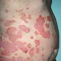 Chronic (large) plaque psoriasis - large well-demarcated ruby-red plaques with silvery white surface scale
