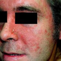 Facial psoriasis (copied with kind permission - Dermatoweb)