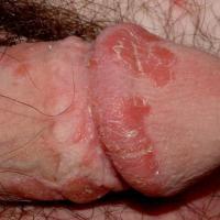 Genital psoriasis (copied with kind permission - Dermatoweb)
